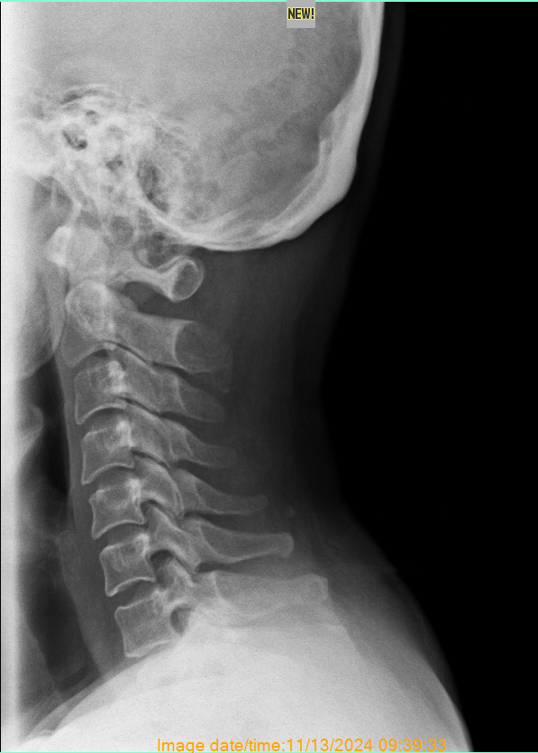 Burnaby Chiropractic X-rays taken by Burnaby chiropractor at Healing Sense Chiropractic Clinic in North Burnaby